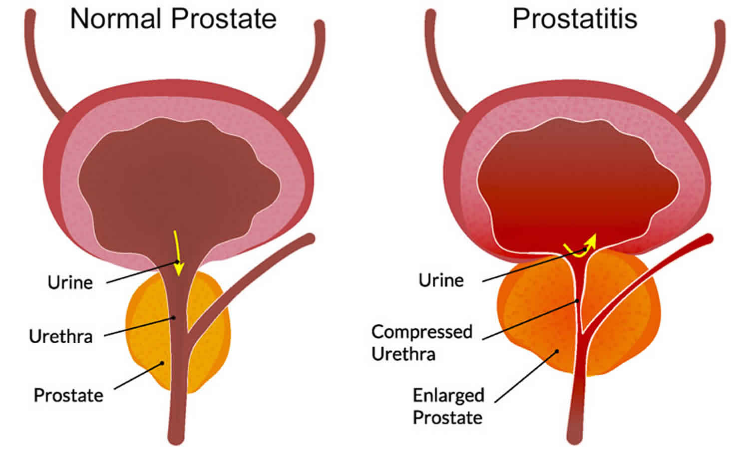 prostata dimensioni